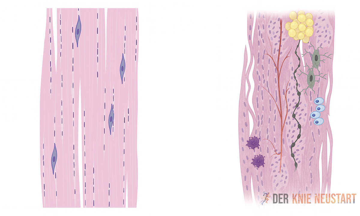 Zellstruktur in der Sehne bei Patellaspitzensyndrom und Springerknie