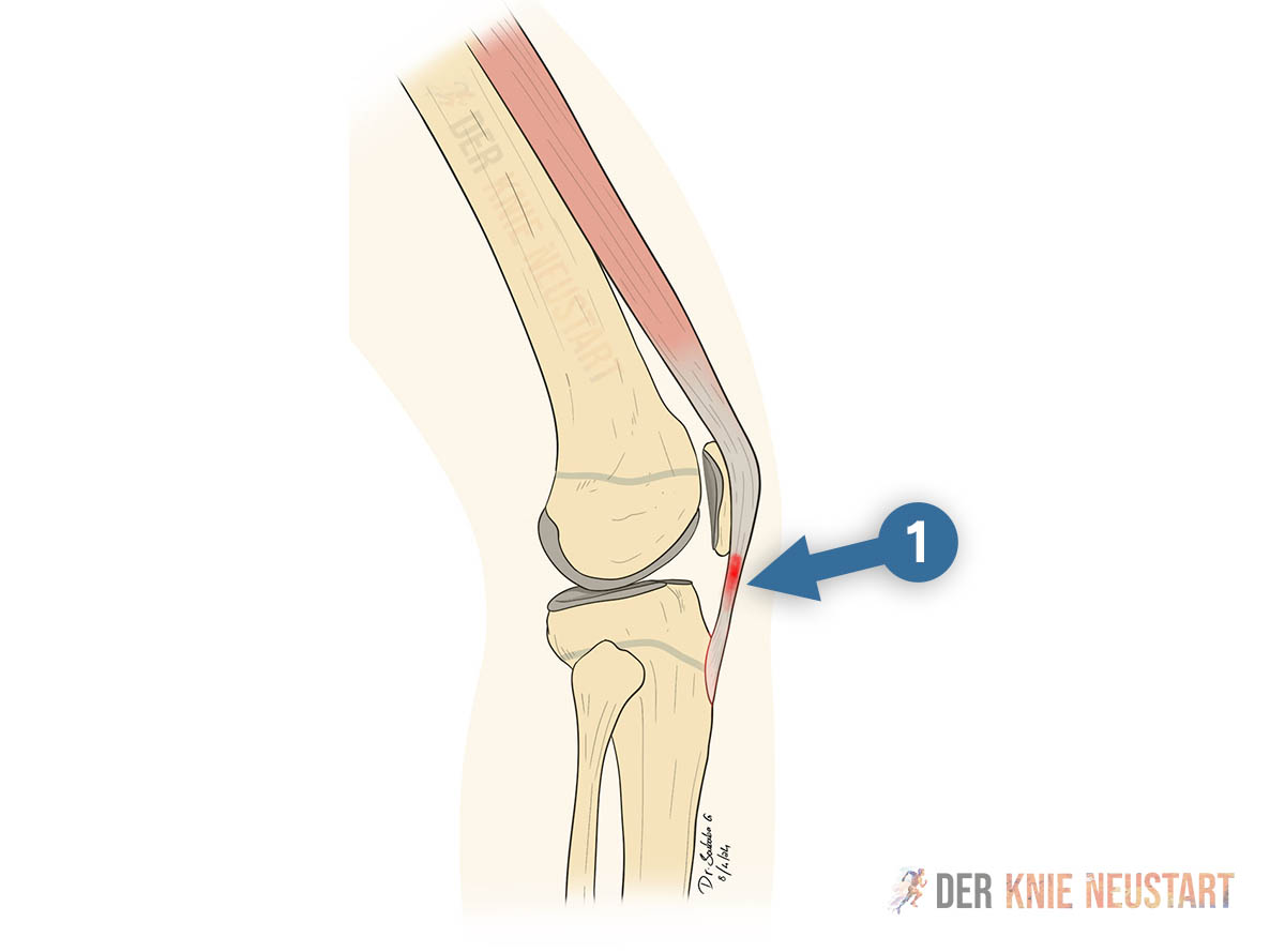 Zeichnung von Patellarspitzensyndrom und der Lokalisation der Schmerzen zur Diagnose